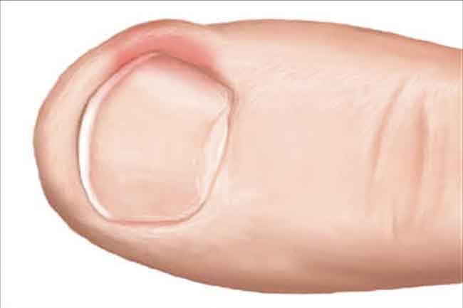 इनग्रोन टोनेल्स के लिए घरेलू उपचार